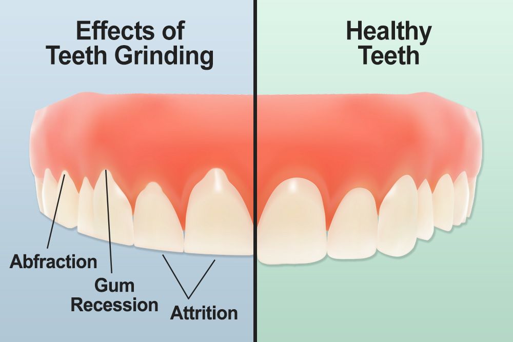 Diagram illustrating effects of teeth grinding