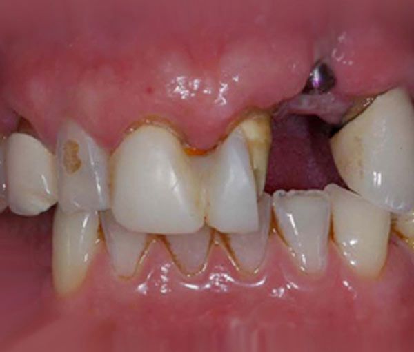 smile with missing teeth, receded gum, and receded bone tissue