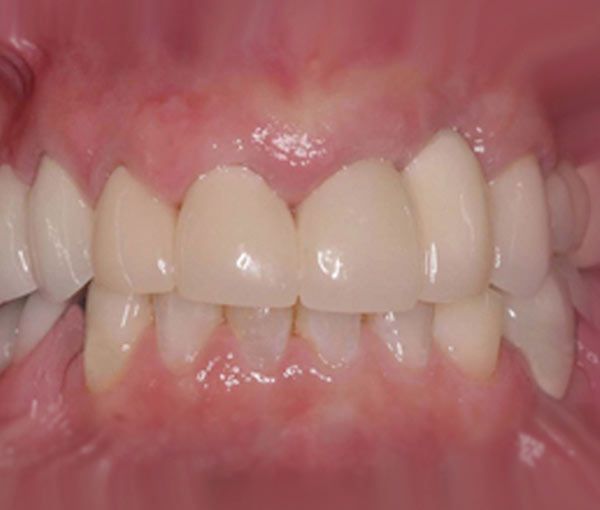 smile after bone grafting and dental implant treatment